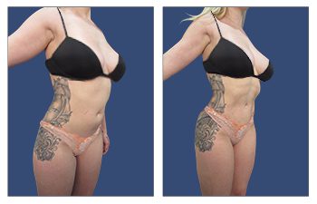 Before and after pictures of a woman's tummy tuck in Southern California.