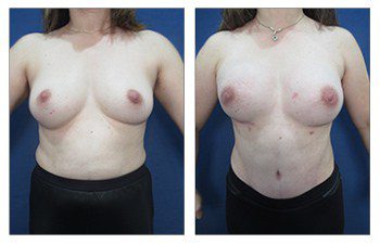 Breast Lift Surgery