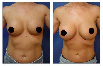 Breast Augmentation Revision to Go Bigger.