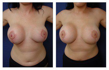 Breast Augmentation Surgery