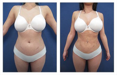 Transform your body with a remarkable tummy tuck before and after results, enhanced by the advanced technique of 4D Liposuction.