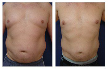 Gynecomastia