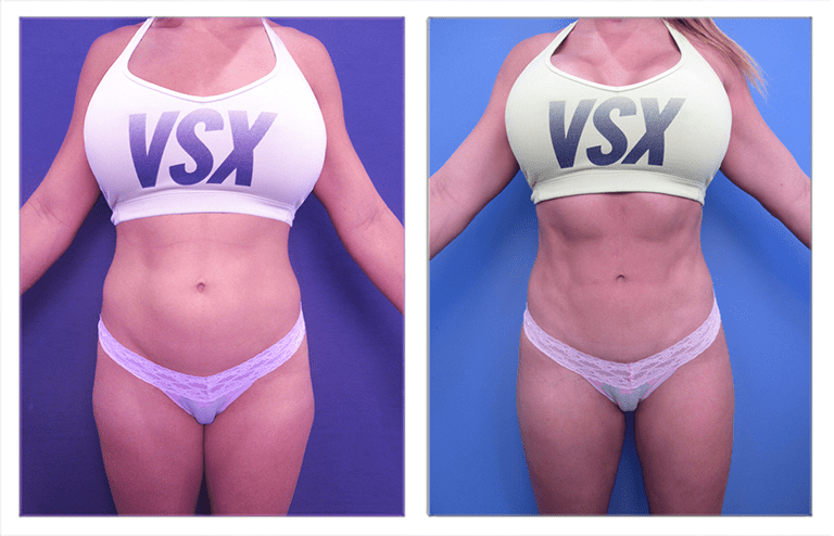 A woman in a bikini undergoing liposuction, demonstrating the before and after results.