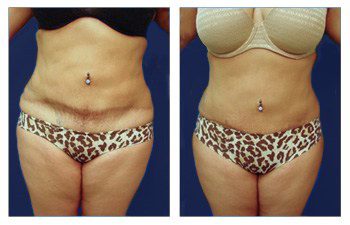 Amazing Results of Mini Tummy Scars