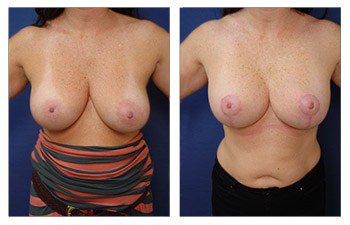 Breast Augmentation Surgery