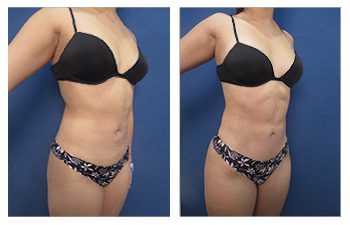 What Kind of Result will I Get After Mini Tummy Tuck? See before and after transformations.