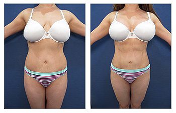 Who qualifies for a mini tummy tuck procedure? See the impressive transformations with before and after photos.