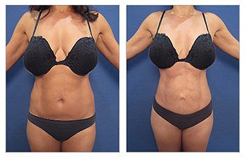 A woman in a bikini showcasing the transformative results of liposuction, revealing a more sculpted figure.