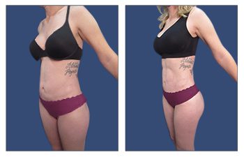 Mini tummy tuck before and after in Beverly Hills.