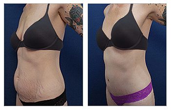 Eliminating Lower Belly Stretch Marks With Tummy Tuck