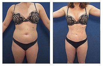 Post-bariatric Tummy Tuck