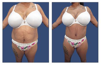 Mini Tummy Tuck Scar