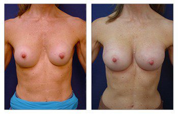 Breast Augmentation Surgery