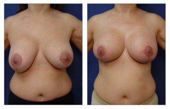 Breast Augmentation Surgery