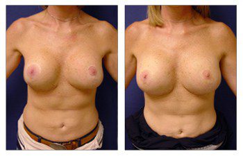 Breast Augmentation Surgery