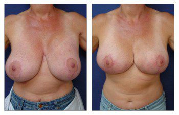 Breast Augmentation Surgery