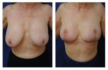 Breast Augmentation Surgery