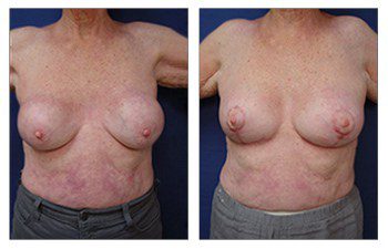 Breast Augmentation Surgery