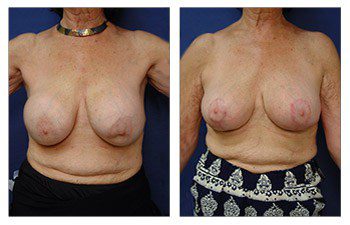 Breast Augmentation Surgery