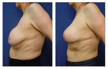 Breast Augmentation Surgery