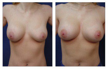 Breast Augmentation Surgery