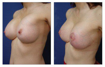 Breast Augmentation Surgery