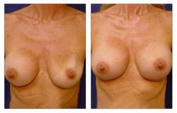 Breast Augmentation Surgery