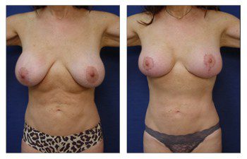 Breast Augmentation Surgery