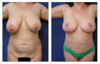 Which breast lift do I need, CPSI.