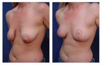 Is Breast Lift Safe, CPSI.