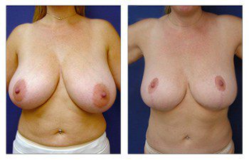 How Does Breast Lift work, CPSI.