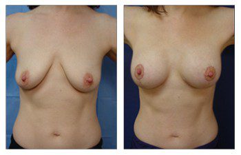 When Is A Breast Lift Covered By Insurance, CPSI.