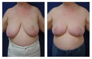 Where Are Breast Lift Scars, CPSI.