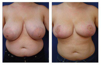 When Do Breast Lift Scars Fade, CPSI.