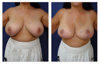 When Do Breast Lift Scars Fade, CPSI.