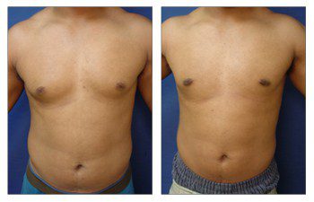 Gynecomastia