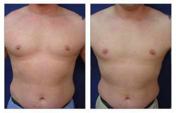 Gynecomastia