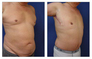 Tummy Tuck Surgery