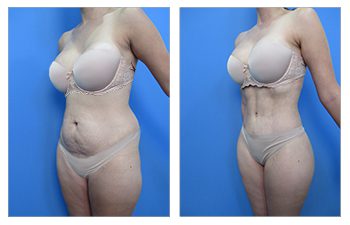 Who Does the Most VASER Liposuction Surgeries