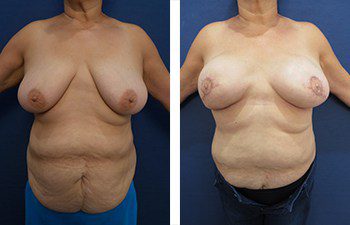 Breasts Look Better After A Breast Reconstruction