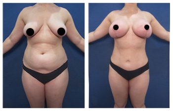 Mommy Makeover - Upper Belly Fullness