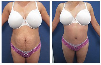 Tummy Tuck 34