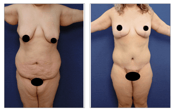 Post Bariatric Body Lift before and after tummy tuck.