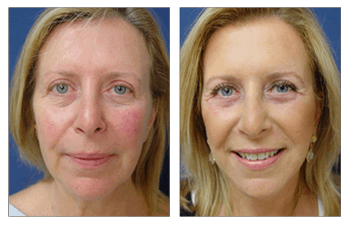 A woman's face before and after a facelift incorporating fat transfer.