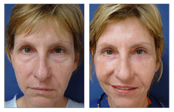 A woman's face before and after a facelift, featuring Fat Transfer and Lower Blepharoplasty enhancements.