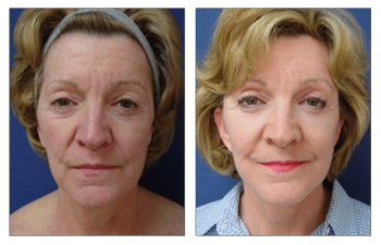 A woman's face undergoes a remarkable transformation through the utilization of fat transfer, offering an alternative to traditional facelift procedures.