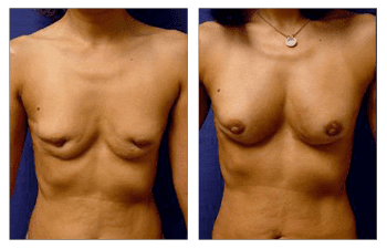 A woman's breasts before and after breast augmentation with fat transfer.