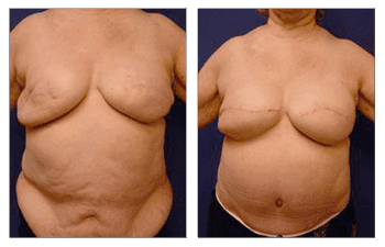 A woman's breast before and after Breast Reconstruction surgery.