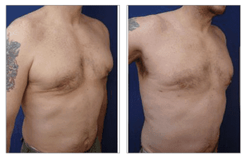 Tummy tuck before and after with botched gynecomastia correction.