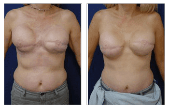 A woman's breast before and after Fat Transfer surgery.